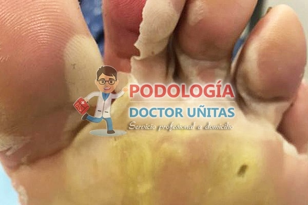 hiperqueratosis