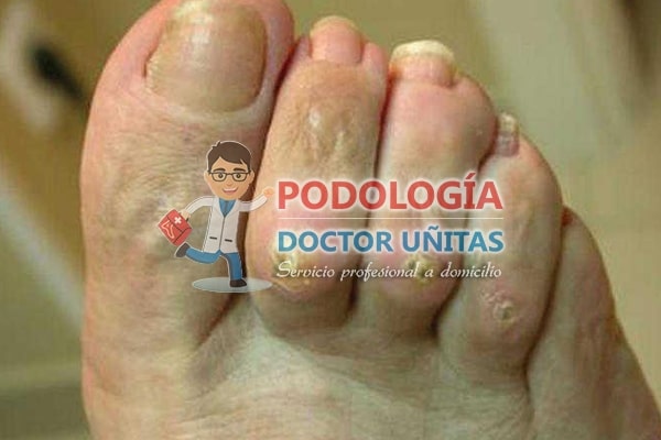 elimina los callos - podologias con garatia y calidad