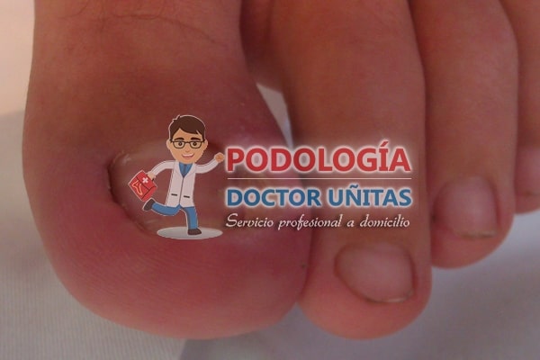 Quitar, extraer, sacar  uero sin dolor podologia docotor uitas
