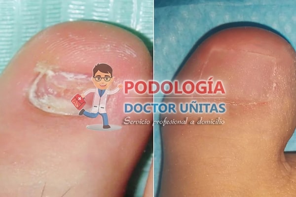 Reconstruccin de uas medicados o antimicoticos